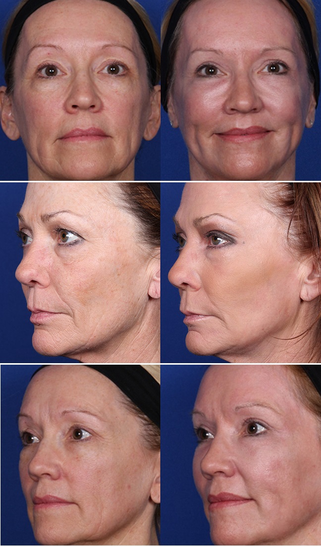 J-Plasma - Thêm một phương pháp làm trẻ hóa da thần kì hơn cả Botox và Laser - Ảnh 1.