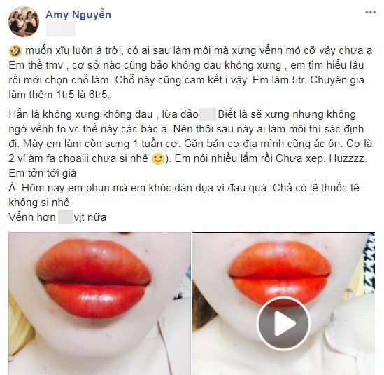 Tin lời thẩm mỹ viện quảng cáo phun môi không sưng, cô gái trẻ làm xong, môi tều như quả táo - Ảnh 2. Tin lời thẩm mỹ viện quảng cáo phun môi không sưng, cô gái trẻ làm xong, môi tều như quả táo - Ảnh 2.