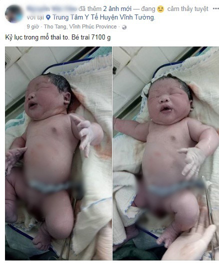 Bé trai sơ sinh 1,7 kg nặng nhất Việt Nam vừa chào đời tại bệnh viện tuyến huyện - Ảnh 1.
