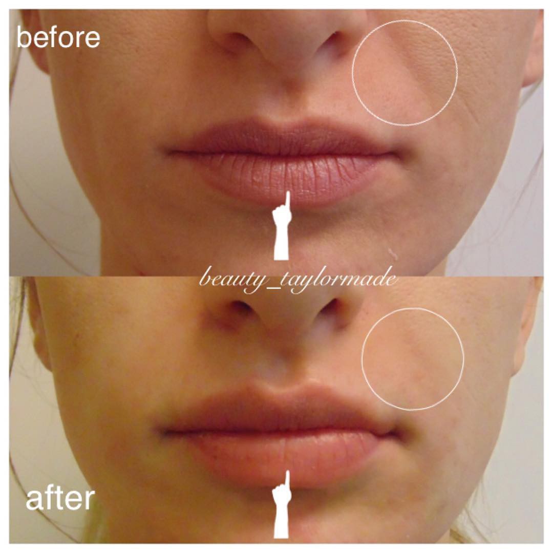 Sau hạ g&ograve; m&aacute; th&igrave; phương ph&aacute;p lấp đầy r&acirc;u rồng sẽ gi&uacute;p c&aacute;c chị em trẻ ra v&agrave;i chục tuổi - Ảnh 14.