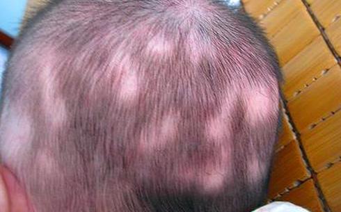 Cậu bé 4 tuổi rụng tóc nghiêm trọng, mẹ phát hoảng khi biết được nguyên nhân - Ảnh 1.