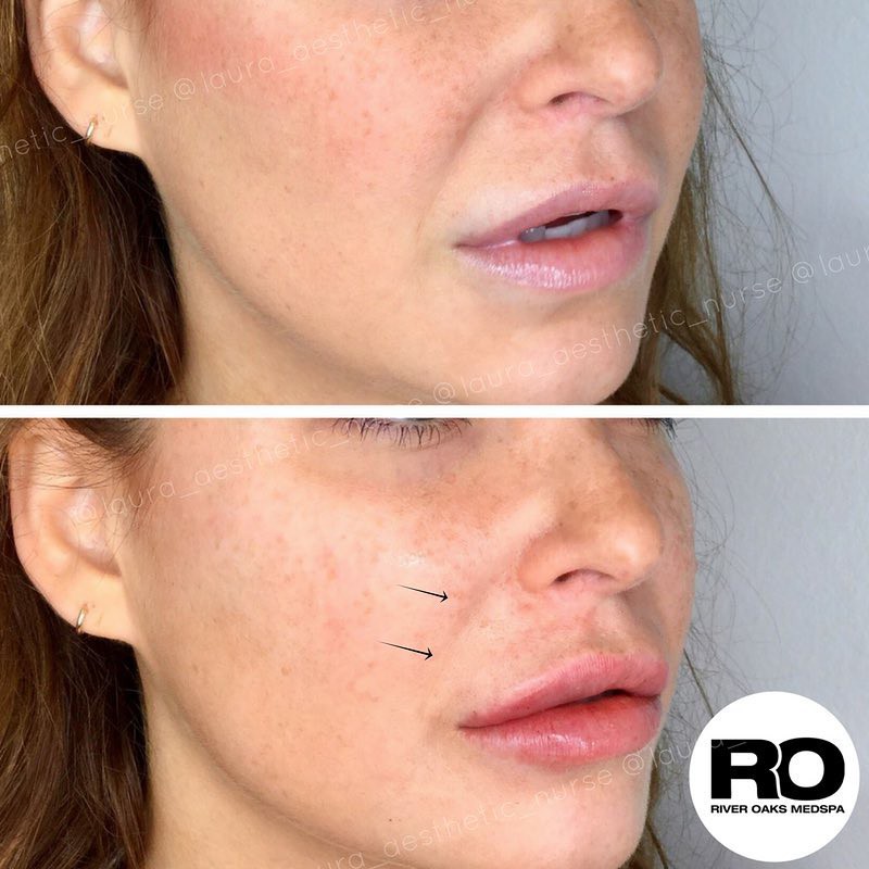 Sau hạ g&ograve; m&aacute; th&igrave; phương ph&aacute;p lấp đầy r&acirc;u rồng sẽ gi&uacute;p c&aacute;c chị em trẻ ra v&agrave;i chục tuổi - Ảnh 16.