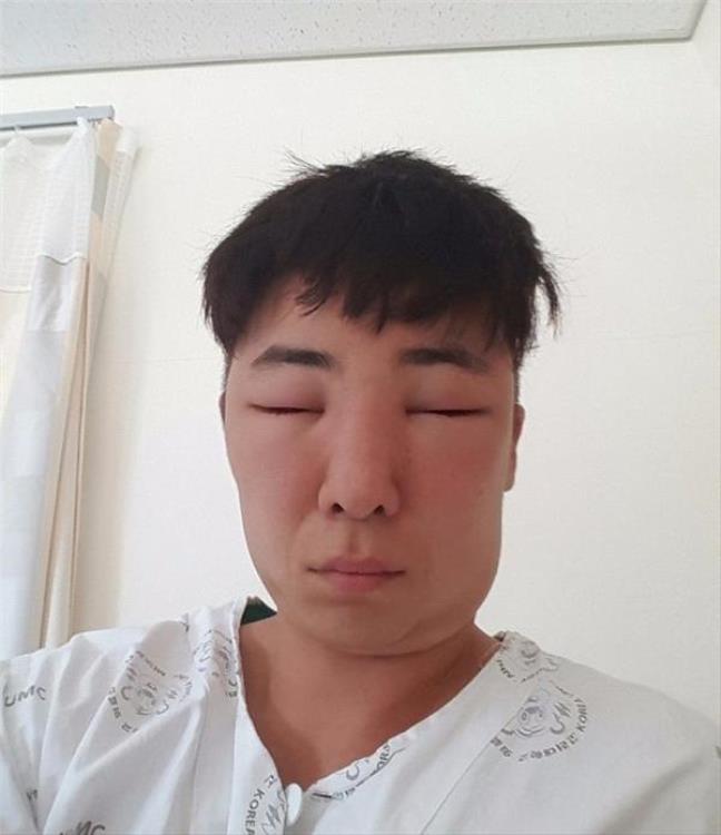 Ham nhuộm tóc giá rẻ, chàng thanh niên nhận lại quả đầu sưng to, mắt không mở được - Ảnh 14. Ham nhuộm tóc giá rẻ, chàng thanh niên nhận lại quả đầu sưng to, mắt không mở được - Ảnh 14.