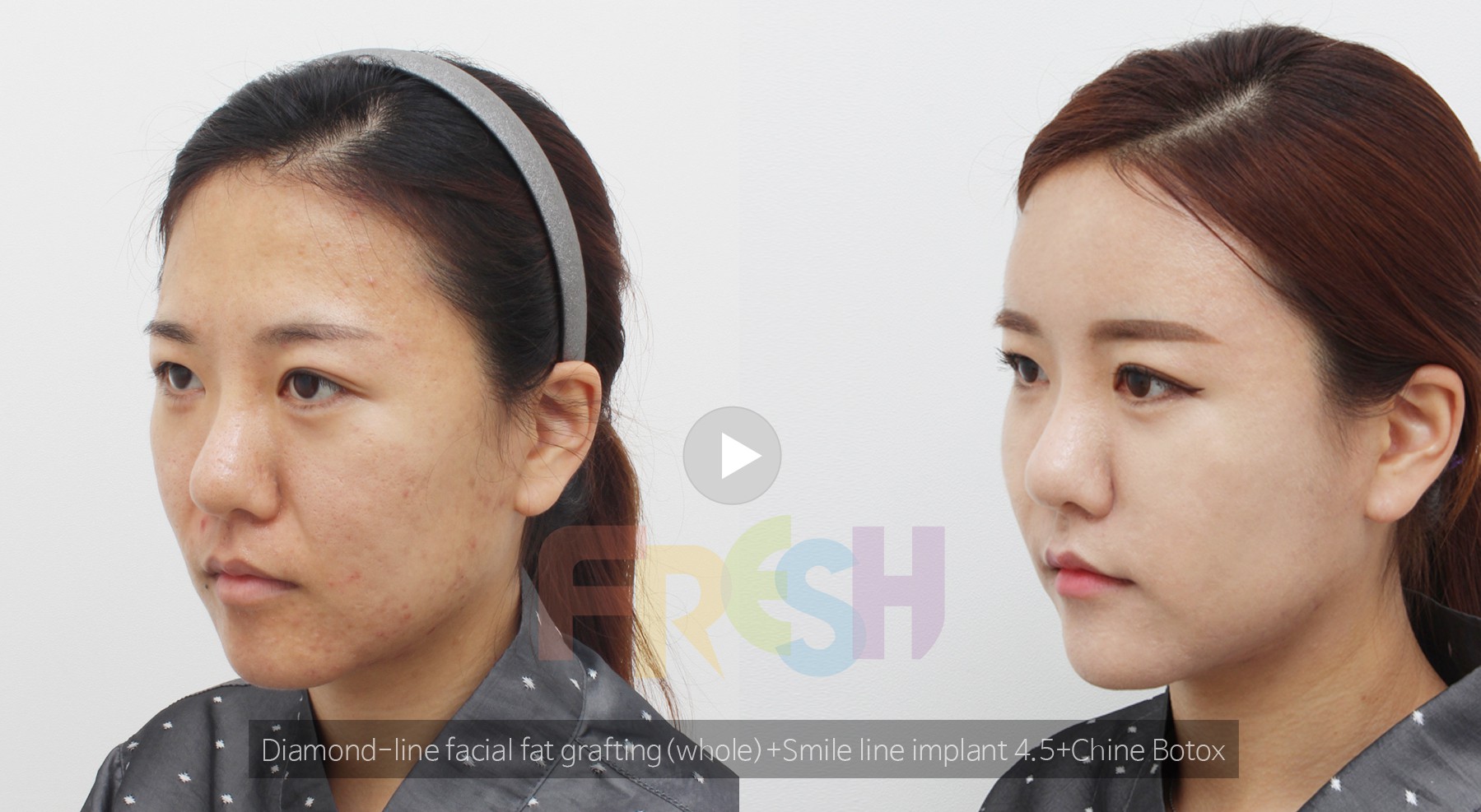 Sau hạ g&ograve; m&aacute; th&igrave; phương ph&aacute;p lấp đầy r&acirc;u rồng sẽ gi&uacute;p c&aacute;c chị em trẻ ra v&agrave;i chục tuổi - Ảnh 17.