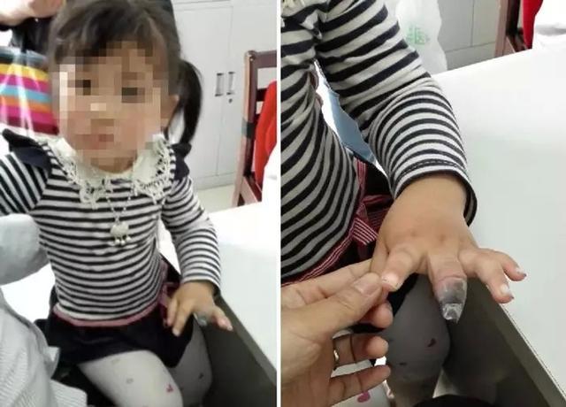 Cẩn trọng với xước măng rô ở trẻ, không khéo ngón tay cũng mất luôn, như cô bé 4 tuổi này - Ảnh 1.