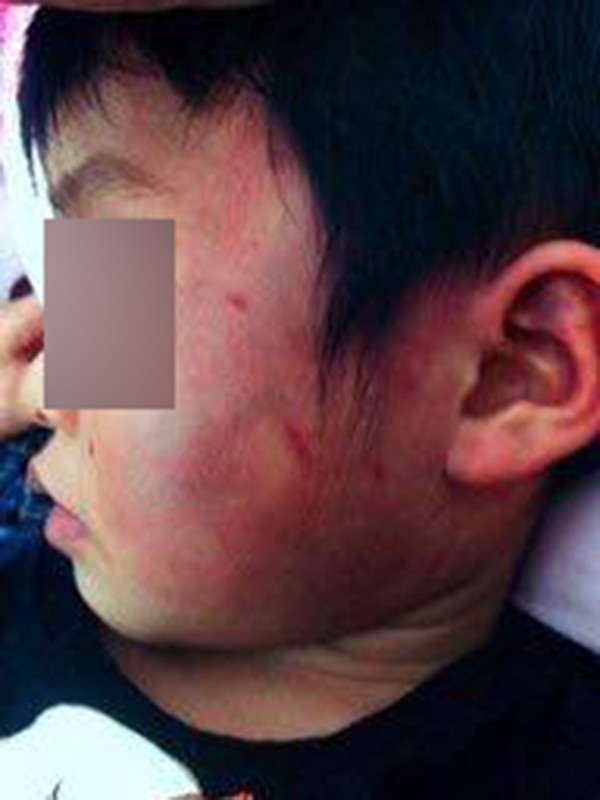 Bắc Giang: Gia đình tố cô giáo đánh con bầm tím toàn thân khi đi học ở trường - Ảnh 3.