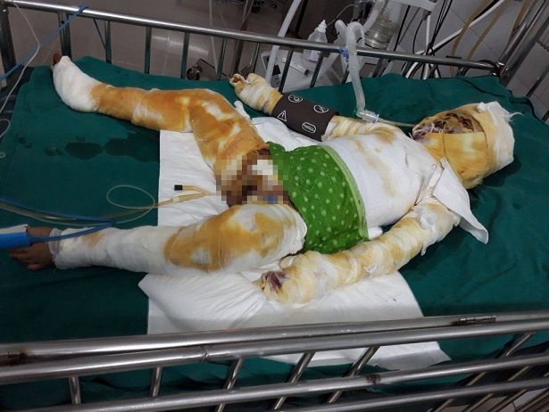 Xót xa hoàn cảnh bé trai sang hàng xóm xem nướng mực bị cồn thiêu như đuốc, hoại tử 2 chân - Ảnh 3. Xót xa hoàn cảnh bé trai sang hàng xóm xem nướng mực bị cồn thiêu như đuốc, hoại tử 2 chân - Ảnh 3.