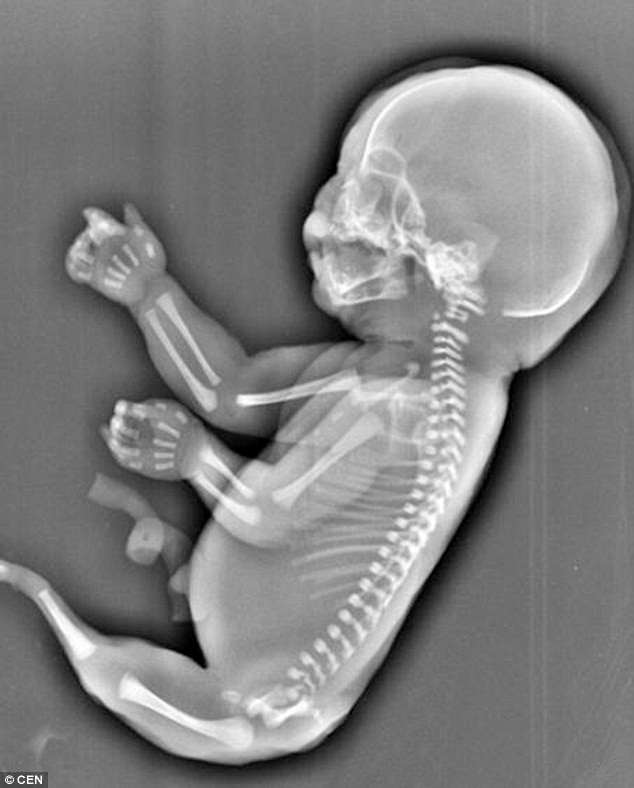 Dù thai đã được 6 tháng, bà mẹ vẫn quyết định bỏ con khi xem hình siêu âm gây sốc này - Ảnh 1.