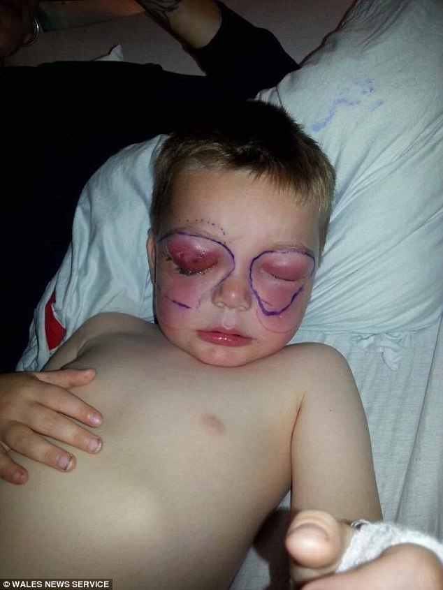 Chỉ sau một cú té, cậu bé 4 tuổi suýt mù và thậm chí mất mạng vì bị nhiễm vi khuẩn ăn thịt người - Ảnh 3.