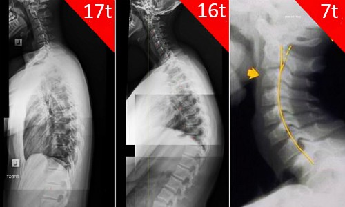 Cảnh báo trẻ sớm bị gù lưng, cong vẹo cột sống chỉ từ một thói quen tưởng chừng như vô hại này - Ảnh 3.