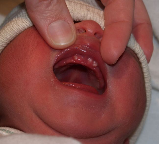 Chuyện lạ chưa từng thấy: Em bé mới chào đời đã đầy một miệng răng - Ảnh 1.
