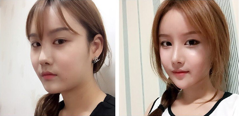 Phẫu thuật hạ xương gò má được tiến hành như thế nào
