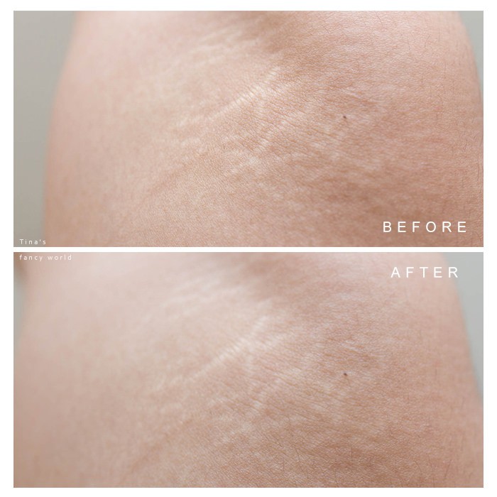 Nghe đồn thổi đ&atilde; nhiều về loại dầu chống rạn da - Bio Oil , nhưng bạn đ&atilde; biết phải sử dụng sao cho đ&uacute;ng - Ảnh 8.