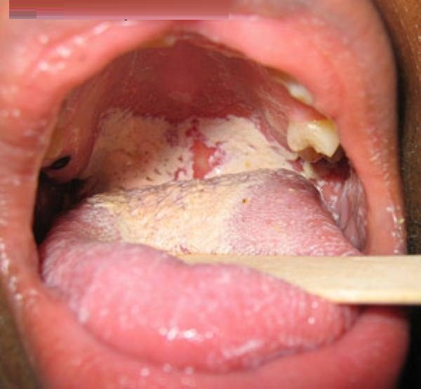 Bệnh lậu lây lan mạnh qua đường oral sex: Những cảnh báo của chuyên gia không được bỏ qua - Ảnh 2.