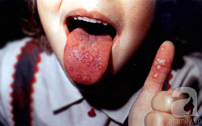 Tổng hợp cách chữa bệnh tay chân miệng cho trẻ hiệu quả theo hướng dẫn Bộ Y Tế - Ảnh 2.