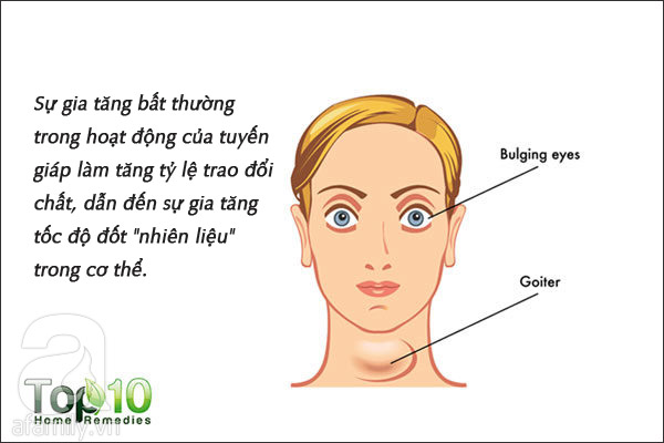 9 bệnh có thể khiến bạn sụt cân không phanh mà không hay biết - Ảnh 3.