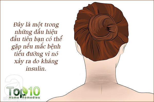 Những tổn thương trên da liên quan đến bệnh tiểu đường: Nhìn là nhận ra ngay - Ảnh 3. Những tổn thương trên da liên quan đến bệnh tiểu đường: Nhìn là nhận ra ngay - Ảnh 3.