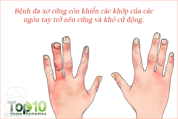 Những tổn thương trên da liên quan đến bệnh tiểu đường: Nhìn là nhận ra ngay - Ảnh 5. Những tổn thương trên da liên quan đến bệnh tiểu đường: Nhìn là nhận ra ngay - Ảnh 5.