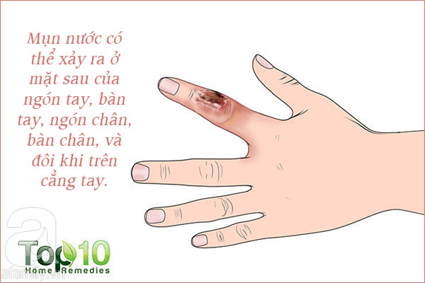 Những tổn thương trên da liên quan đến bệnh tiểu đường: Nhìn là nhận ra ngay - Ảnh 7. Những tổn thương trên da liên quan đến bệnh tiểu đường: Nhìn là nhận ra ngay - Ảnh 7.