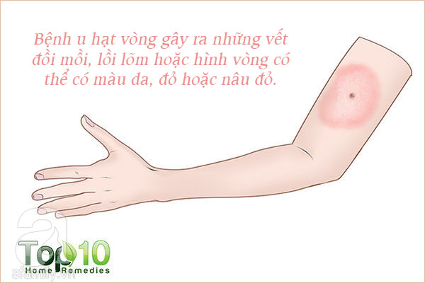 Những tổn thương trên da liên quan đến bệnh tiểu đường: Nhìn là nhận ra ngay - Ảnh 9. Những tổn thương trên da liên quan đến bệnh tiểu đường: Nhìn là nhận ra ngay - Ảnh 9.