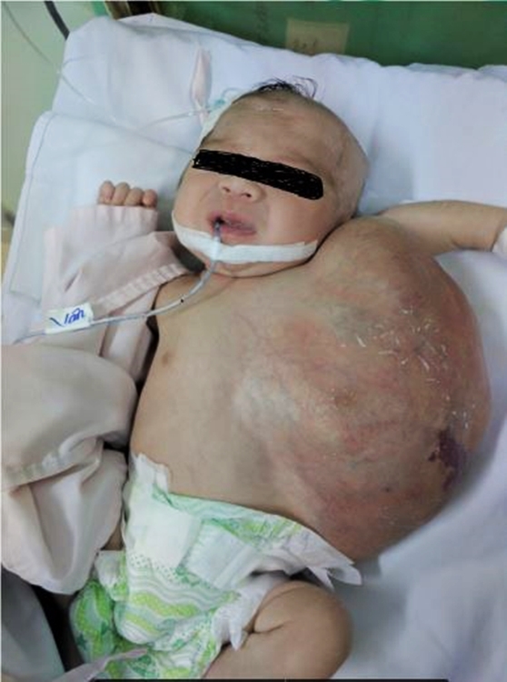 TP.HCM: Vừa chào đời, bé gái đã mang khối u khủng trên cơ thể khiến tính mạng nguy hiểm - Ảnh 2.