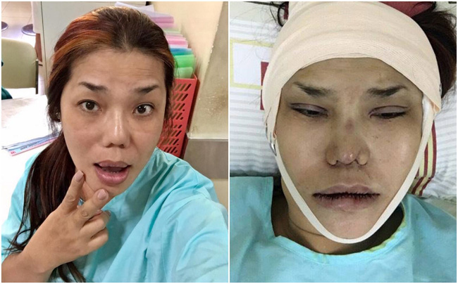 Sao Việt đang có xu hướng công khai quá trình phẫu thuật thẩm mỹ trên mạng xã hội - Ảnh 26.
