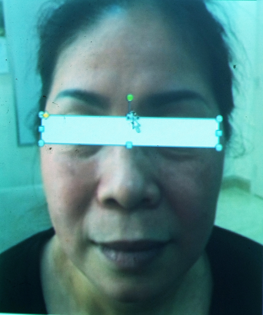 Tự mua thuốc &ldquo;Đ&ocirc;ng y b&aacute;t vị&rdquo; về thoa, mặt người phụ nữ nổi nhiều nốt sần, đỏ thẫm như m&aacute;u - Ảnh 3.