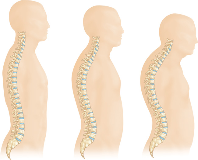 6 bệnh thường gặp nhưng đôi khi lại bị nhầm tưởng nhầm là đau lưng đơn thuần - Ảnh 5.