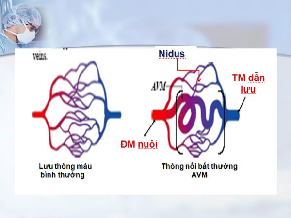 Dị dạng động tĩnh mạch - căn bệnh khiến nữ diễn viên như quả bom hẹn giờ - Ảnh 7.