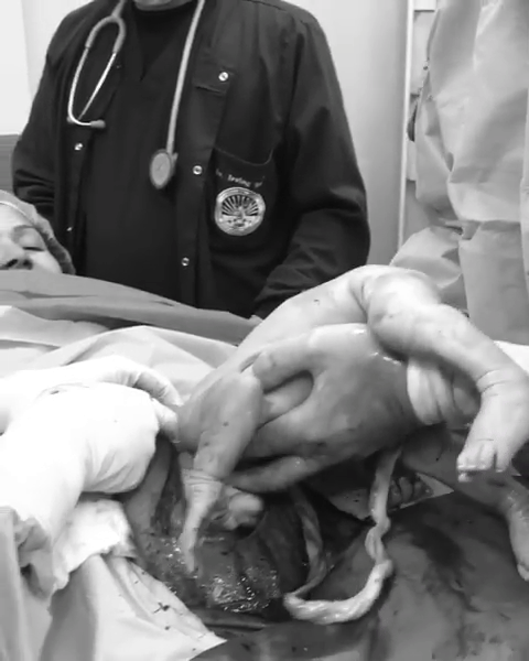 Khoảnh khắc tuyệt vời khi em bé ngôi mông từ từ chui ra khỏi bụng mẹ - Ảnh 3.