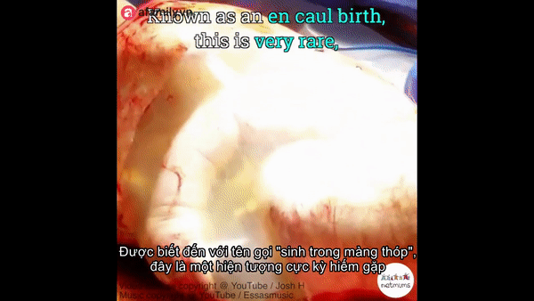 Cận cảnh em bé chào đời trong một ca sinh mổ hiếm gặp chỉ xảy ra với xác xuất 1/80.000 ca - Ảnh 3.
