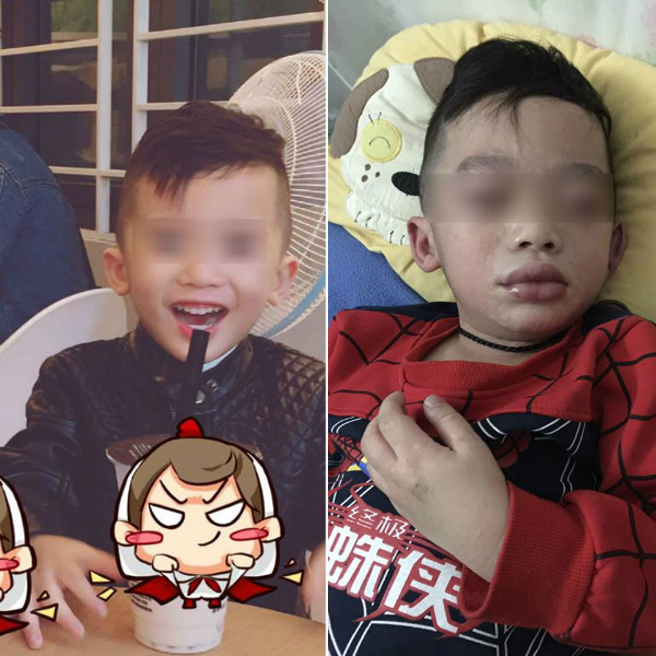 Mùng 3 Tết, bé trai nhập viện trong tình trạng mặt mũi sưng vù vì uống trà sữa? - Ảnh 5. Mùng 3 Tết, bé trai nhập viện trong tình trạng mặt mũi sưng vù vì uống trà sữa? - Ảnh 5.