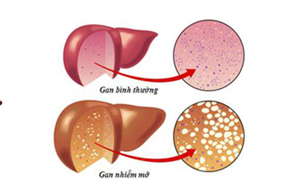 Gan nhiễm mỡ vì ăn kiêng để giảm cân nhanh - Ảnh 1.