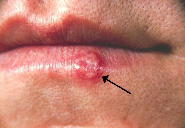 Những sự thật bạn chưa biết về bệnh Herpes, đọc đi nếu không muốn sợ hãi với chúng - Ảnh 1.