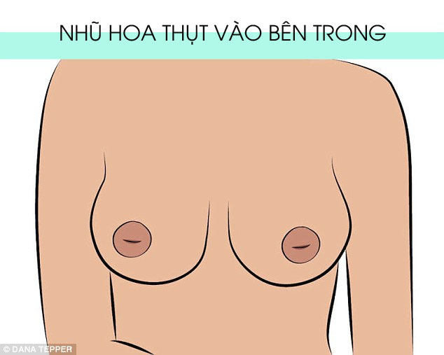 Hình dạng nhũ hoa cũng cảnh báo tình trạng sức khỏe của bạn - Ảnh 4.