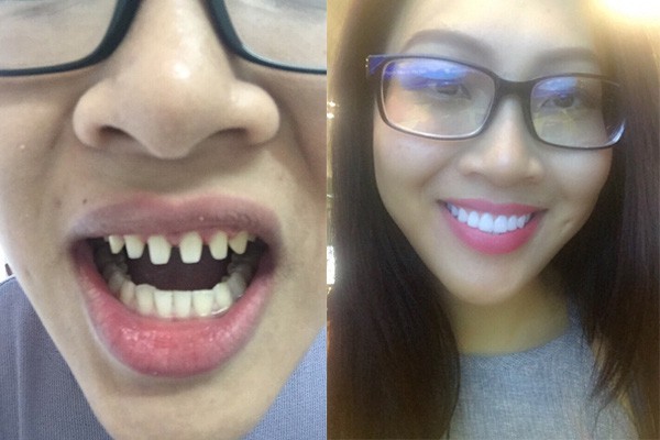 Nếu tháo hết răng sứ, liệu có ai dám nhìn Nguyễn Thị Thành khi cười? - Ảnh 4.