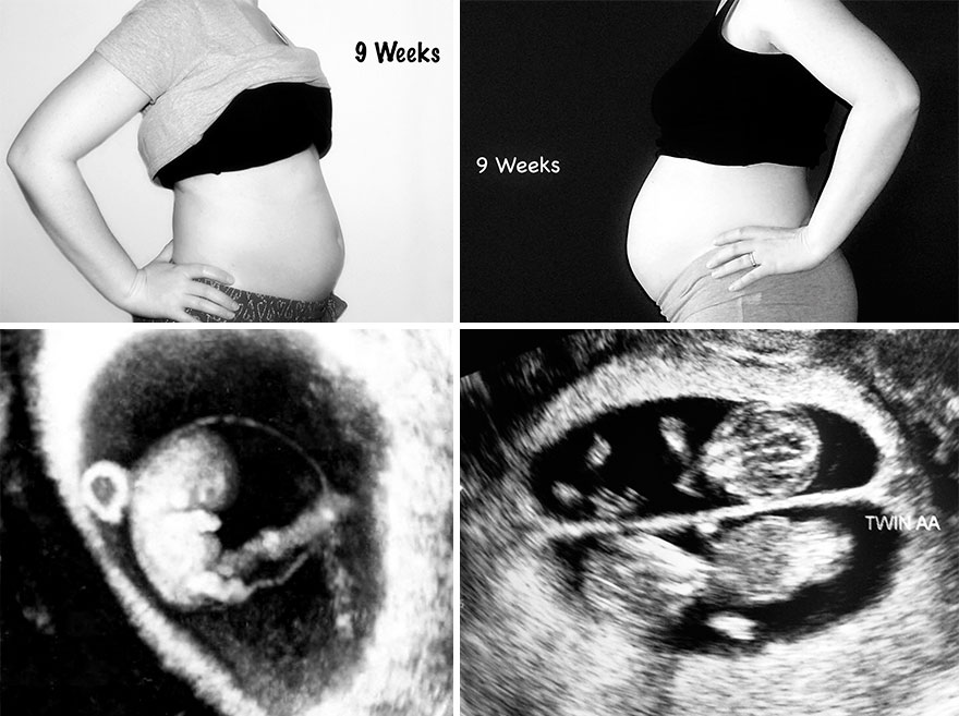 Беременность 9 неделя отзывы. Беременность двойней по неделям. 10 Недель двойня живот.