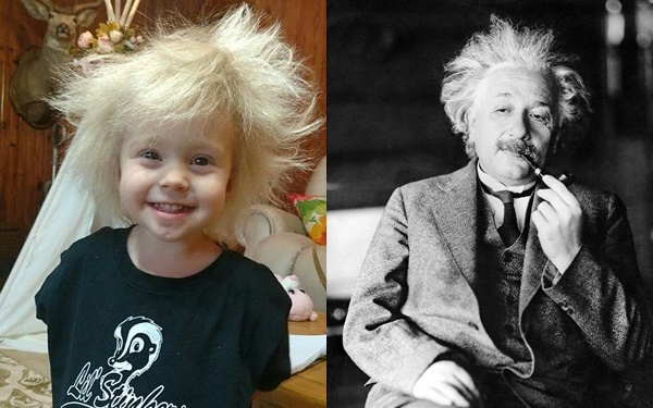 Lý giải khoa học đằng sau mái tóc kỳ lạ, trông như hoa bồ công anh của cô bé 2 tuổi - Ảnh 3.