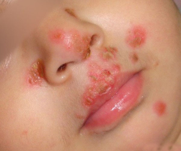 Thêm 1 trường hợp trẻ nhiễm virus Herpes chỉ vì nụ hôn của người lớn - Ảnh 2.