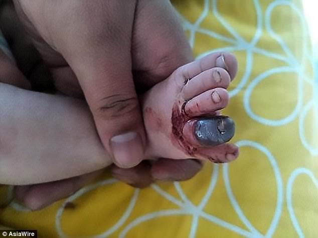 Ngón chân bé trai 2 tháng tuổi bị hoại tử, có nguy cơ phải cắt bỏ chì vì 1 sợi tóc vương vãi - Ảnh 1.
