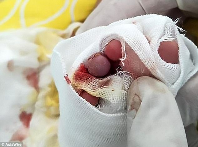 Ngón chân bé trai 2 tháng tuổi bị hoại tử, có nguy cơ phải cắt bỏ chì vì 1 sợi tóc vương vãi - Ảnh 2.