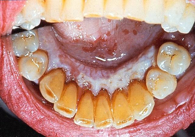 Những nguyên nhân gây nên hiện tượng lưỡi trắng - hóa ra có cả nguyên nhân nguy hiểm không ngờ - Ảnh 3. Những nguyên nhân gây nên hiện tượng lưỡi trắng - hóa ra có cả nguyên nhân nguy hiểm không ngờ - Ảnh 3.