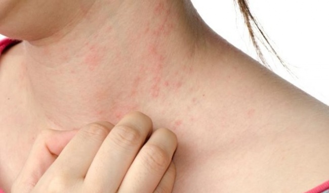 Những nguyên nhân gây nên hiện tượng lưỡi trắng - hóa ra có cả nguyên nhân nguy hiểm không ngờ - Ảnh 5. Những nguyên nhân gây nên hiện tượng lưỡi trắng - hóa ra có cả nguyên nhân nguy hiểm không ngờ - Ảnh 5.