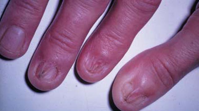 7 nguyên nhân dẫn đến bệnh Lichen phẳng - căn bệnh viêm da không có cách điều trị - Ảnh 1.