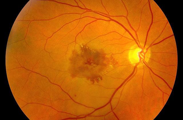 Chuyên gia nhãn khoa chỉ ra tất cả những lý do khiến mắt bạn bỗng nhiên bị mờ đi và cách khắc phục - Ảnh 6.