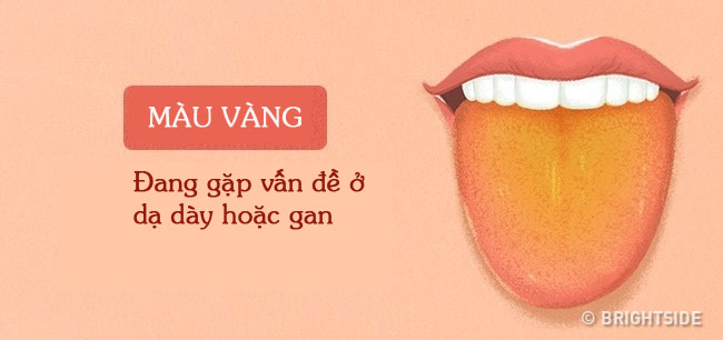 Bằng cách kiểm tra lưỡi mỗi ngày, rất có thể bạn sẽ phát hiện sớm những căn bệnh mình đang gặp phải - Ảnh 7.