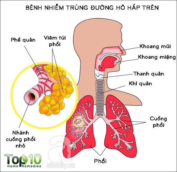 Để phòng và chữa bệnh nhiễm trùng đường hô hấp trên, bạn có thể làm 7 biện pháp này tại nhà - Ảnh 1.