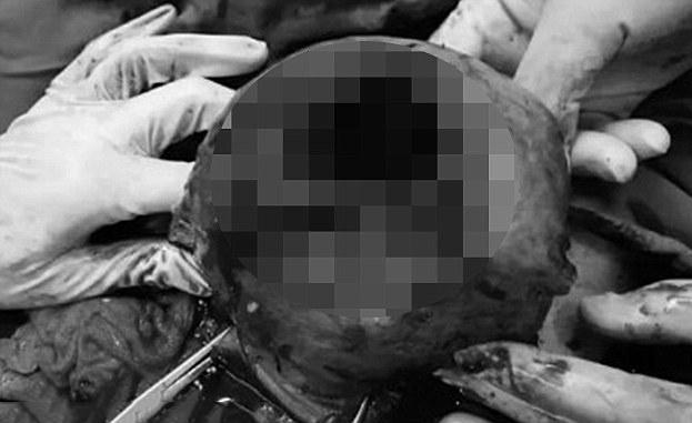 Hy hữu: Thai phụ suýt chết vì đứa bé trong bụng đá rách tử cung - Ảnh 2.