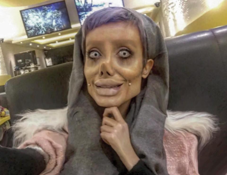 Photos of a girl who had surgery 50 times to look like Angelina Jolie were exposed - Photo 7.