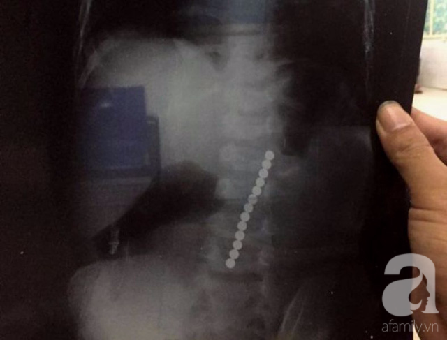Nghệ An: Bé trai 2 tuổi nhập viện cấp cứu vì nuốt 13 viên bi nam châm - Ảnh 1.